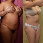 African American Tummy Tuck (Abdominoplasty) Before & After Patient #12563
