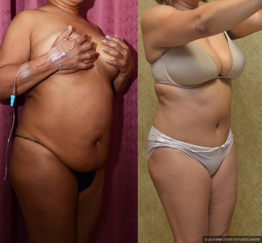 African American Tummy Tuck (Abdominoplasty) Before & After Patient #12563