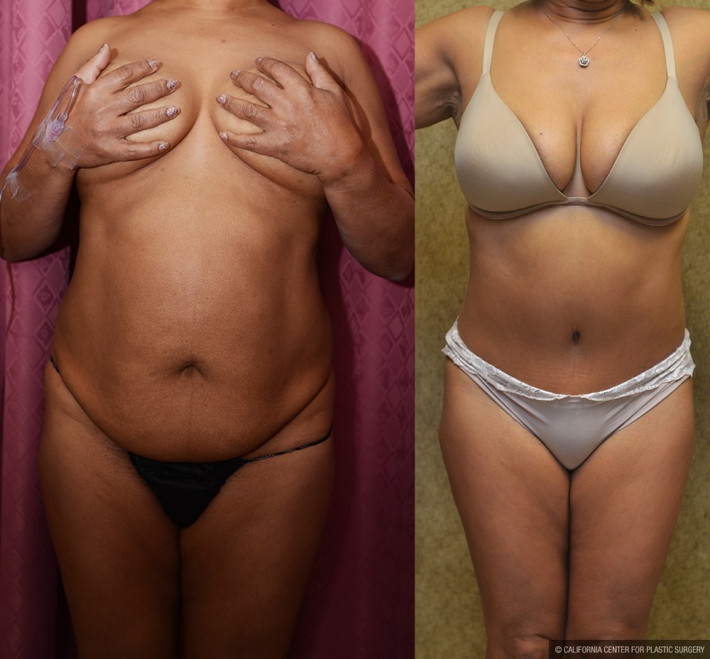 African American Tummy Tuck (Abdominoplasty) Before & After Patient #12563