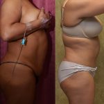 African American Tummy Tuck (Abdominoplasty) Before & After Patient #12563