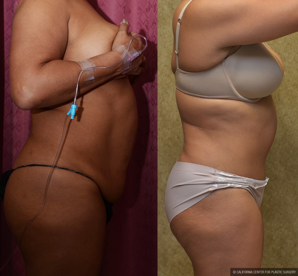 African American Tummy Tuck (Abdominoplasty) Before & After Patient #12563