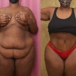 African American Tummy Tuck (Abdominoplasty) Before & After Patient #12555