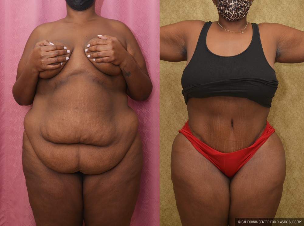 African American Tummy Tuck (Abdominoplasty) Before & After Patient #12555