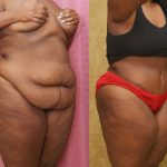 African American Tummy Tuck (Abdominoplasty) Before & After Patient #12555