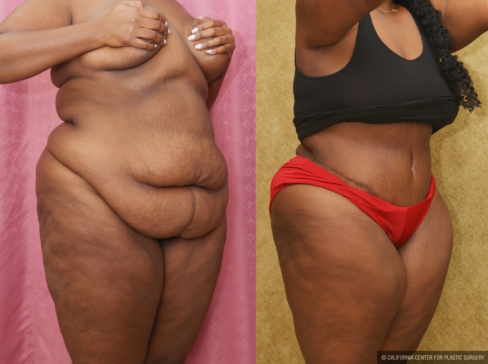 African American Tummy Tuck (Abdominoplasty) Before & After Patient #12555
