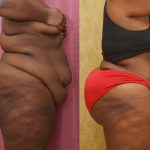 African American Tummy Tuck (Abdominoplasty) Before & After Patient #12555