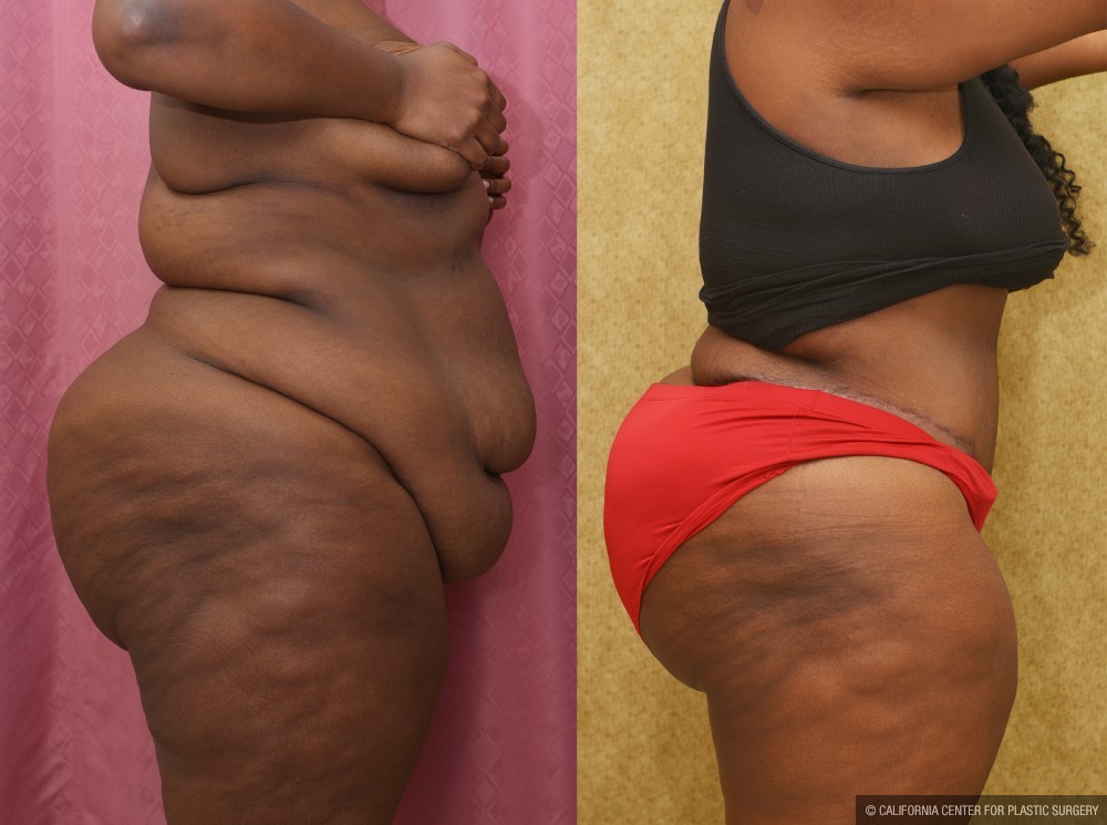 African American Tummy Tuck (Abdominoplasty) Before & After Patient #12555