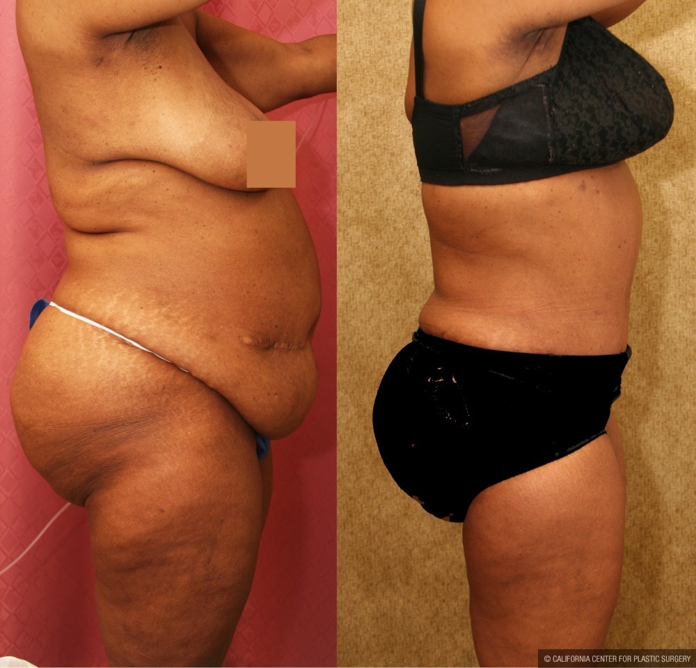 African American Tummy Tuck (Abdominoplasty) Before & After Patient #12585