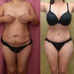 Tummy Tuck (Abdominoplasty) Small Size Before & After Patient #12592