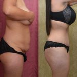 Tummy Tuck (Abdominoplasty) Small Size Before & After Patient #12592