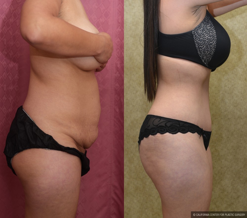 Tummy Tuck (Abdominoplasty) Small Size Before & After Patient #12592
