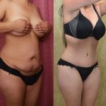 Tummy Tuck (Abdominoplasty) Small Size Before & After Patient #12592