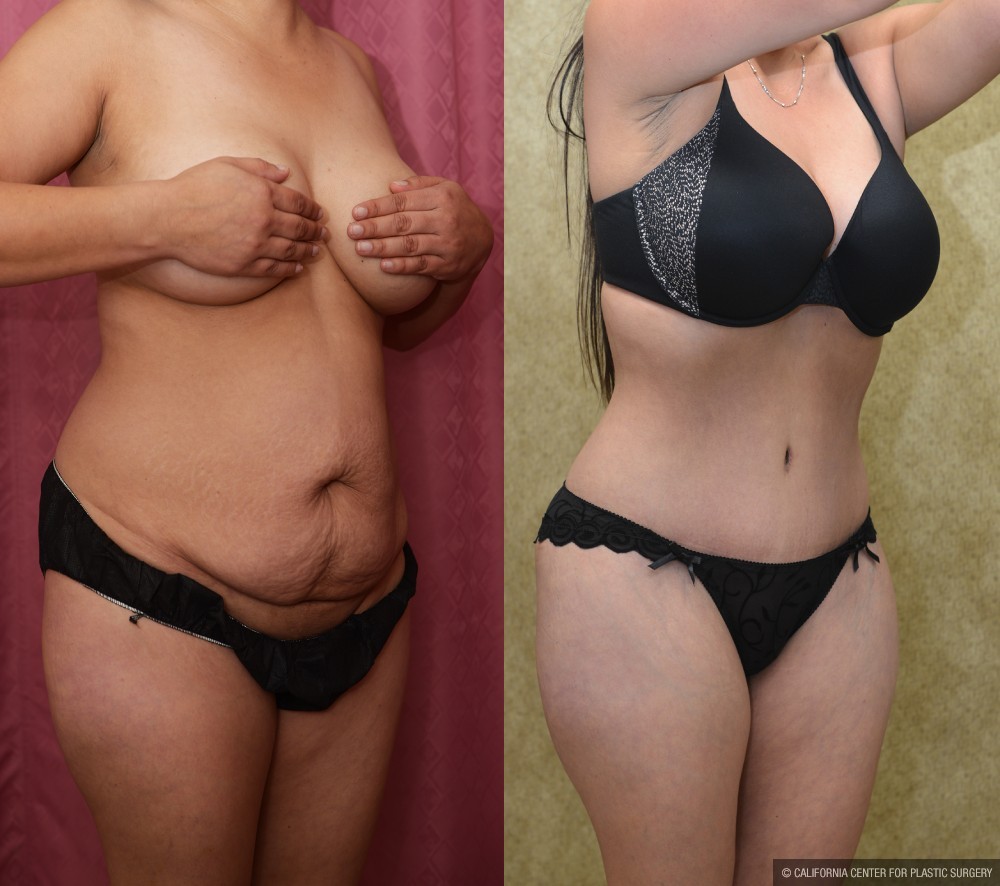 Tummy Tuck (Abdominoplasty) Small Size Before & After Patient #12592