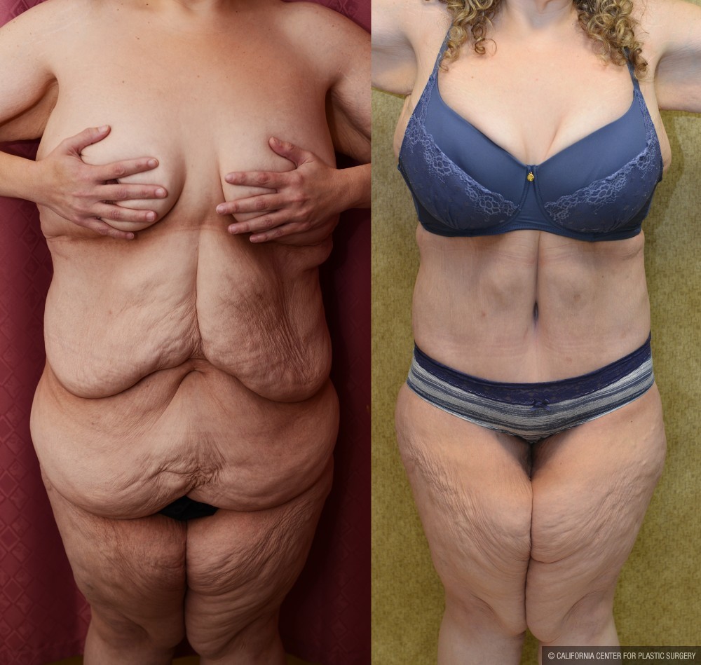 Body Lift Before & After Patient #12519