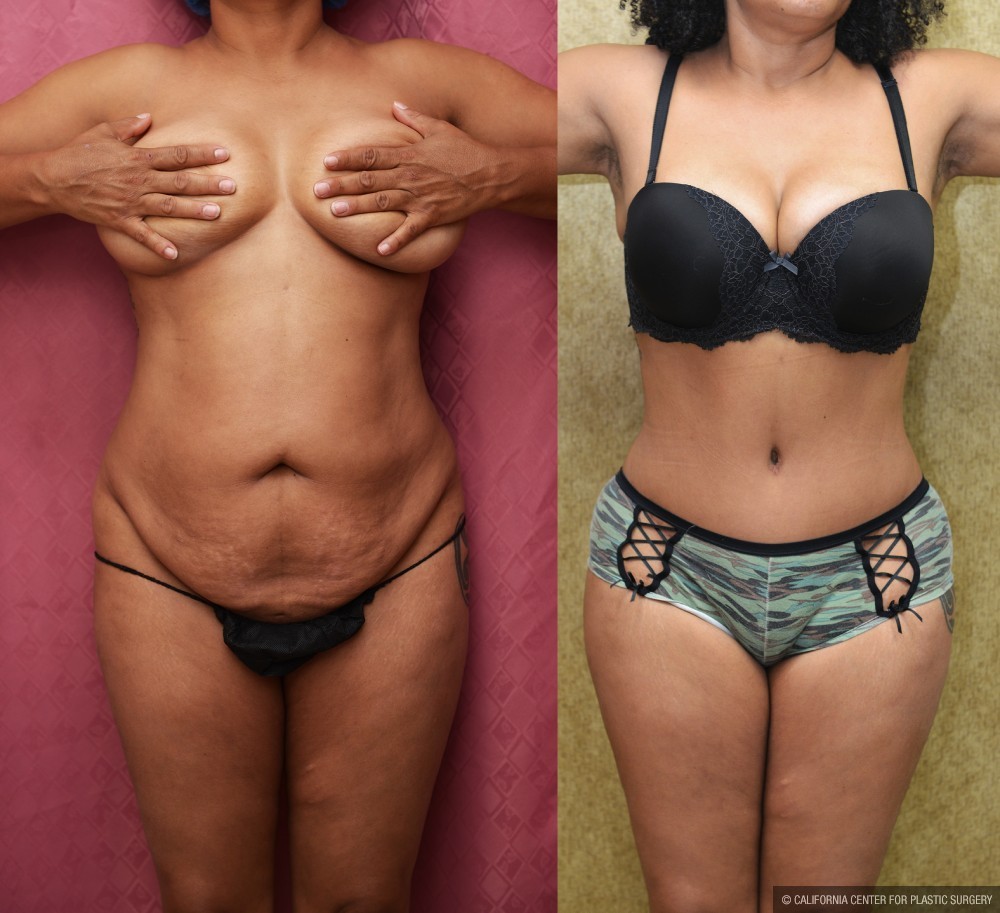 African American Tummy Tuck Before & After Patient #12536