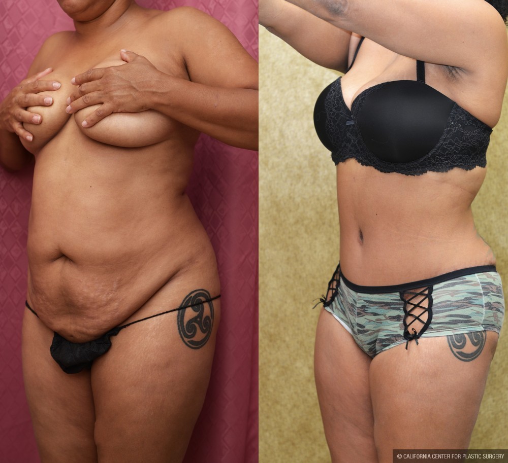 African American Tummy Tuck (Abdominoplasty) Before & After Patient #12536