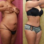 African American Tummy Tuck (Abdominoplasty) Before & After Patient #12536