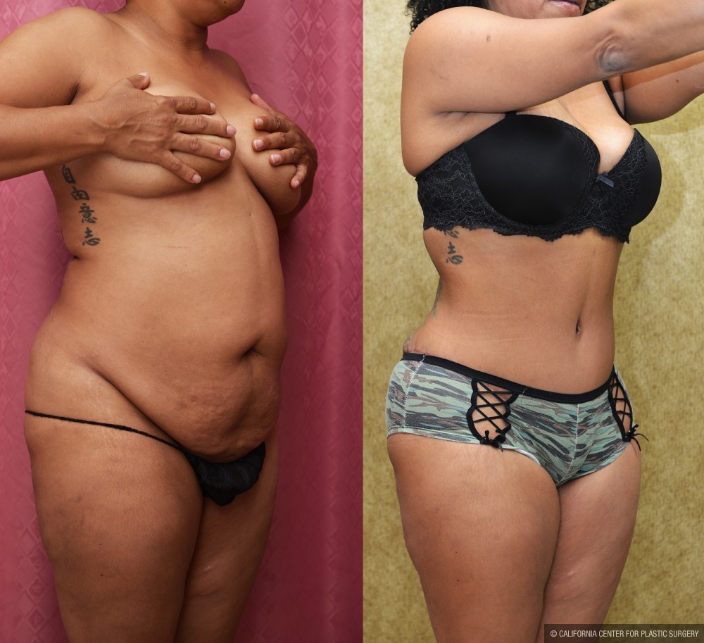 African American Tummy Tuck (Abdominoplasty) Before & After Patient #12536
