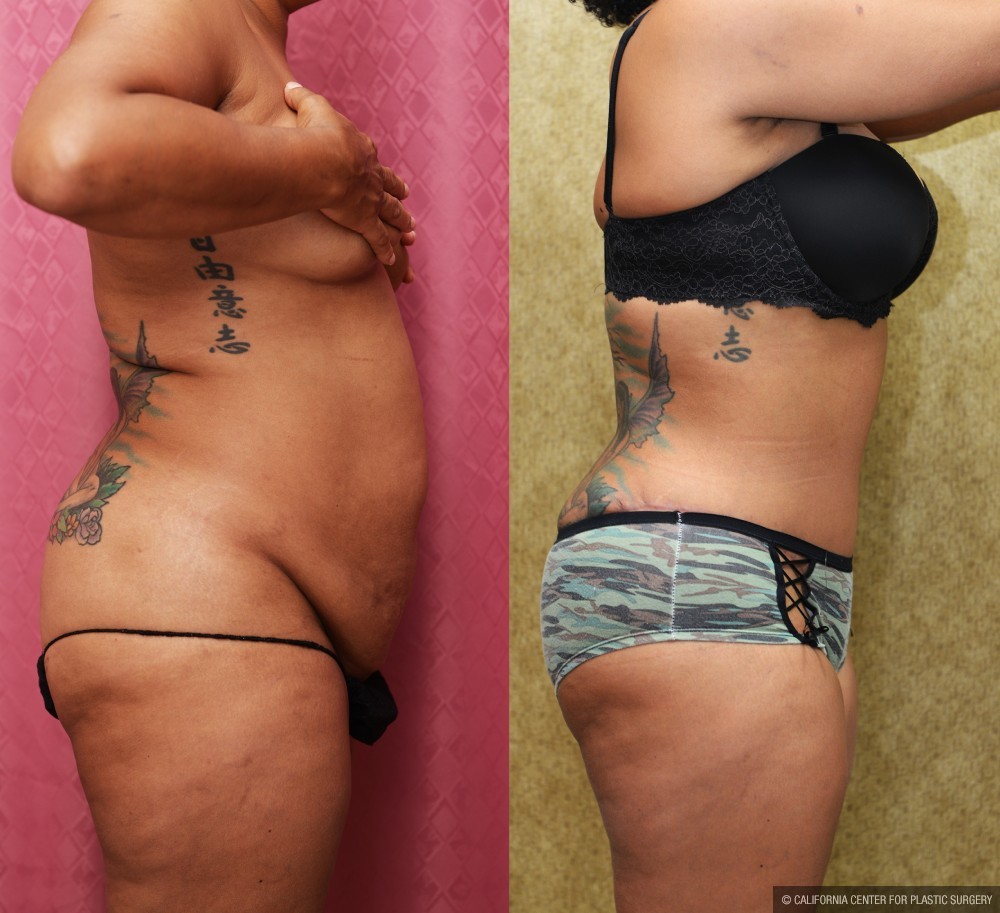 African American Tummy Tuck (Abdominoplasty) Before & After Patient #12536