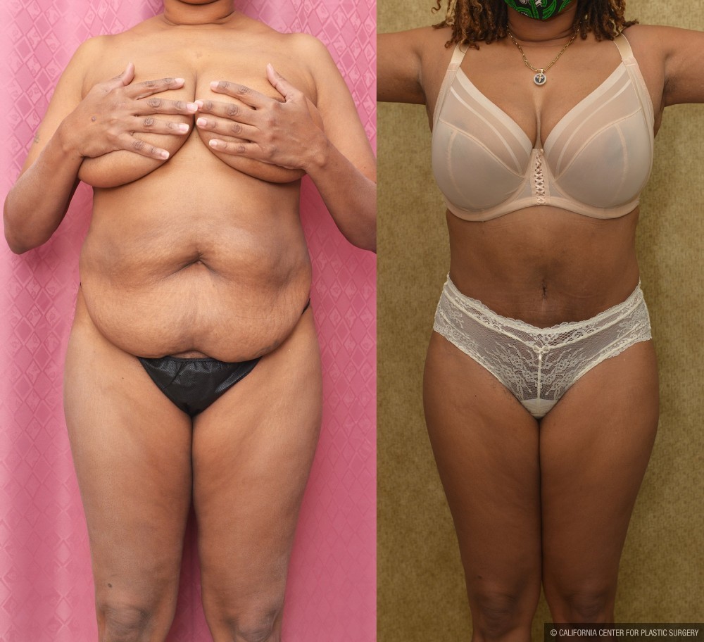 African American Tummy Tuck (Abdominoplasty) Before & After Patient #12581