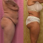 African American Tummy Tuck (Abdominoplasty) Before & After Patient #12581