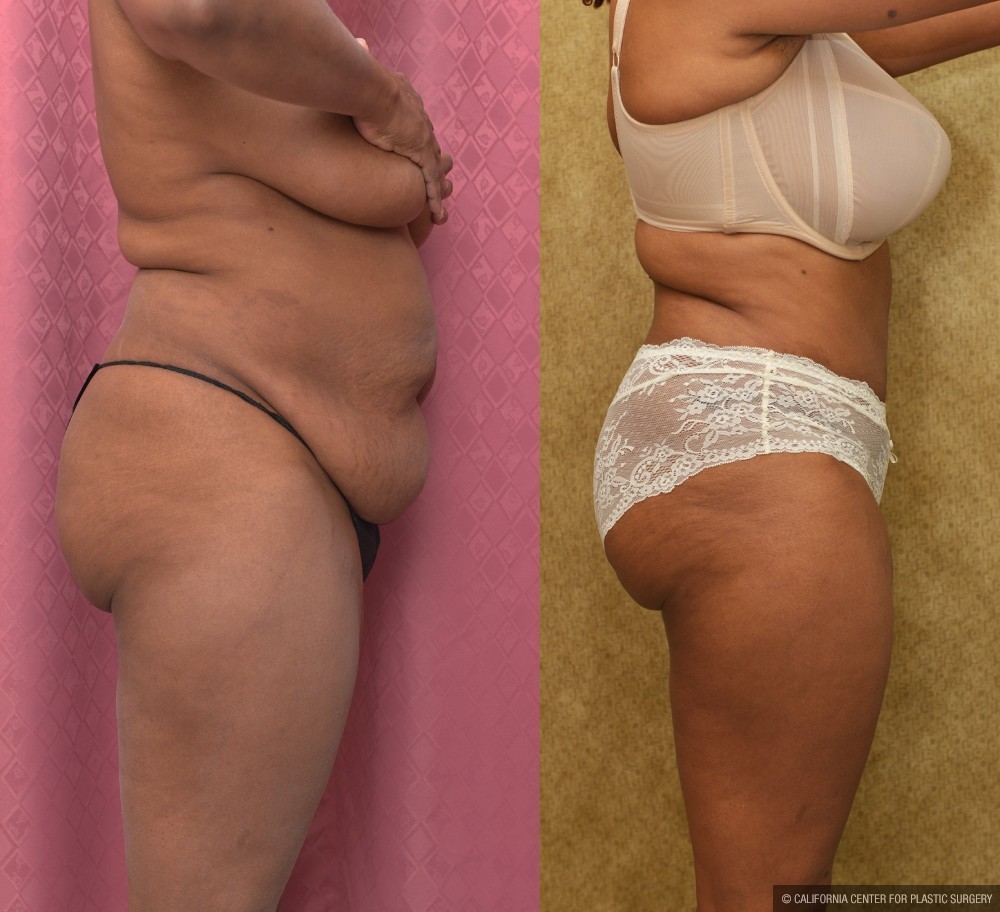 African American Tummy Tuck (Abdominoplasty) Before & After Patient #12581