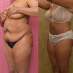 African American Tummy Tuck (Abdominoplasty) Before & After Patient #12581