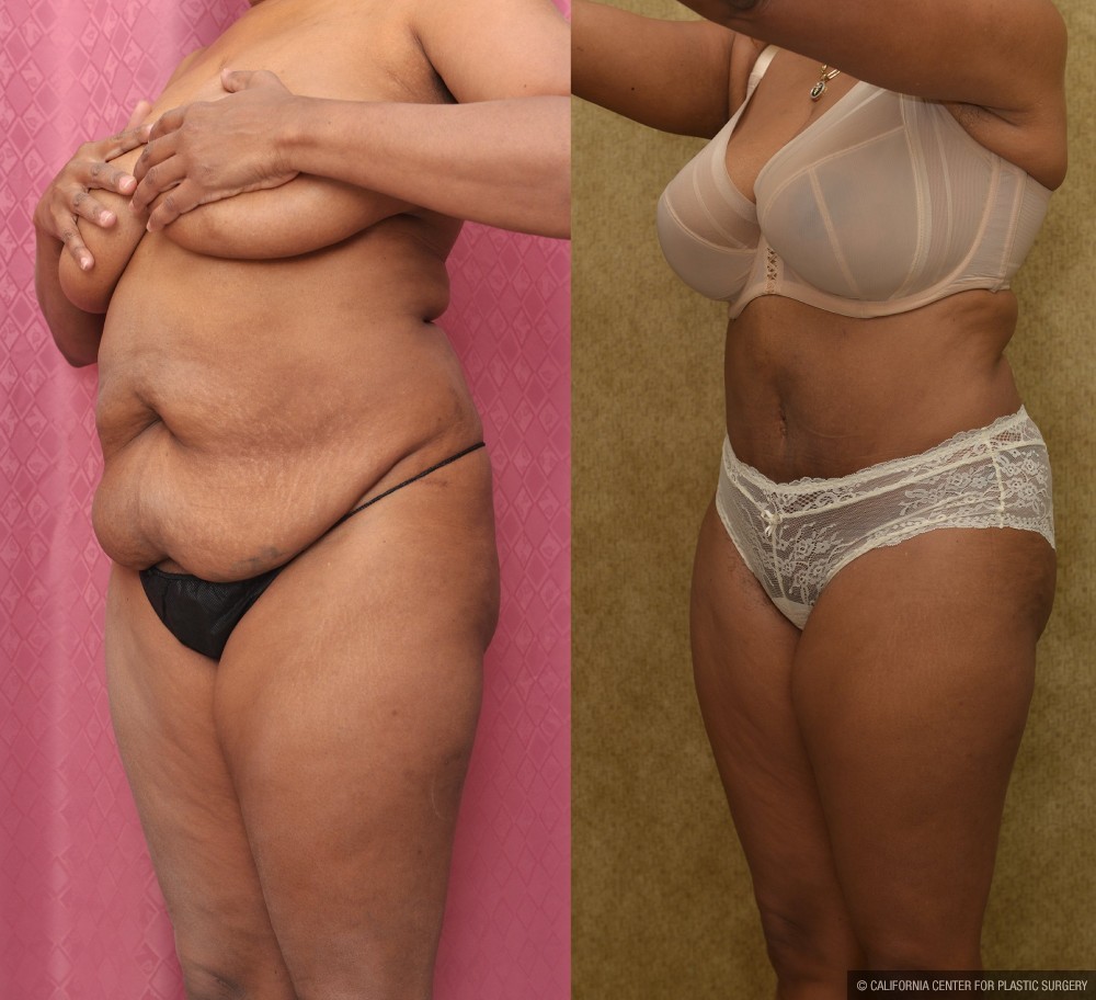 African American Tummy Tuck (Abdominoplasty) Before & After Patient #12581