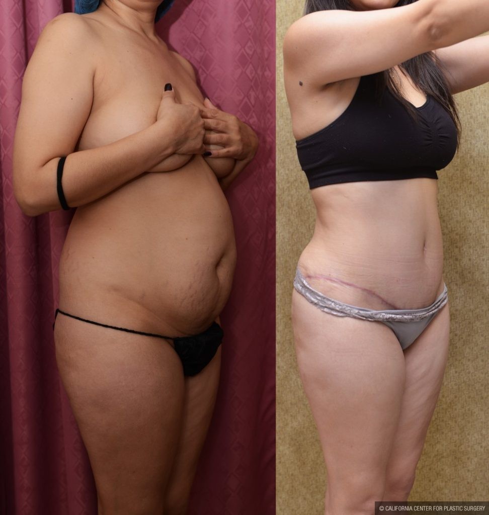 Tummy Tuck (Abdominoplasty) Small Size Before & After Patient #12600