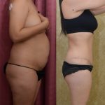 Tummy Tuck (Abdominoplasty) Small Size Before & After Patient #12600