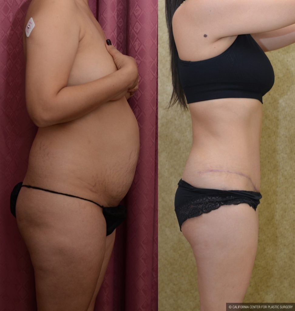 Tummy Tuck (Abdominoplasty) Small Size Before & After Patient #12600