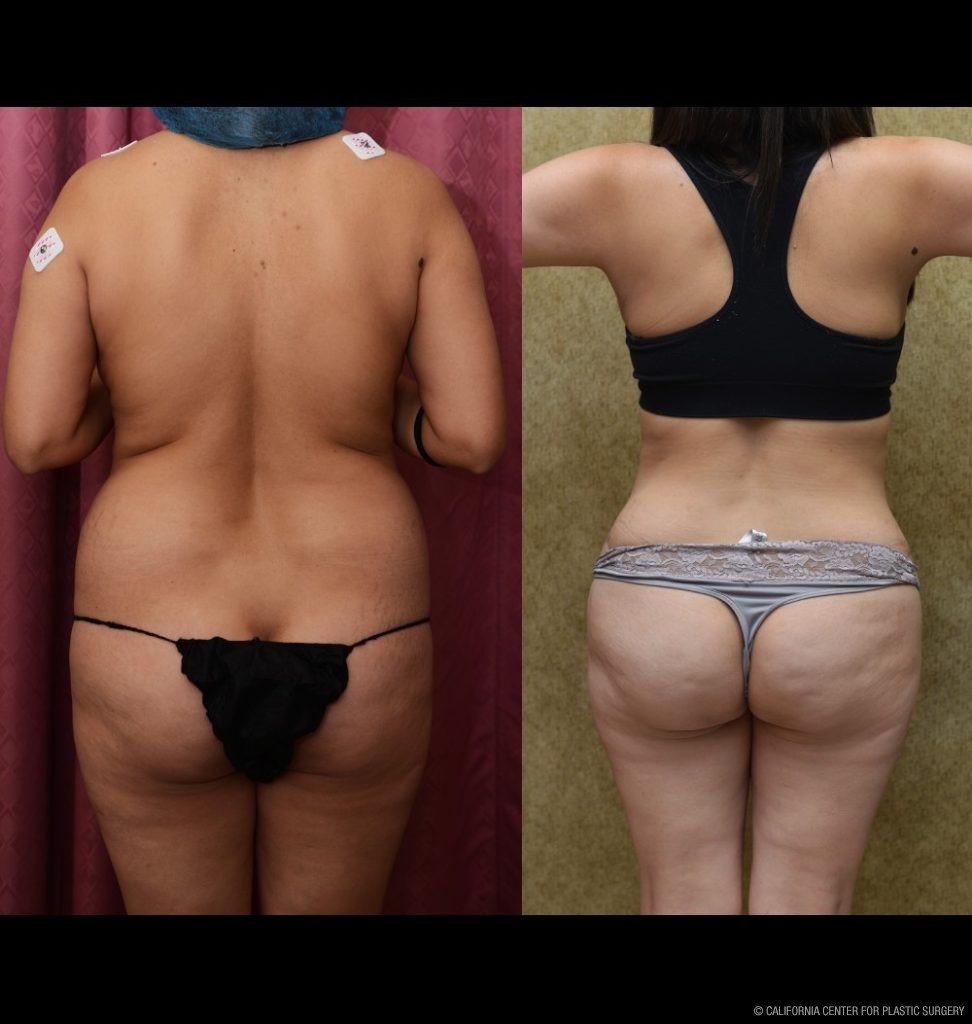 Tummy Tuck (Abdominoplasty) Small Size Before & After Patient #12600