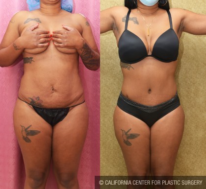 Tummy Tuck (Abdominoplasty) Small Size Before & After Patient #12606