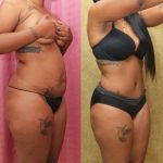 African American Tummy Tuck (Abdominoplasty) Before & After Patient #12559