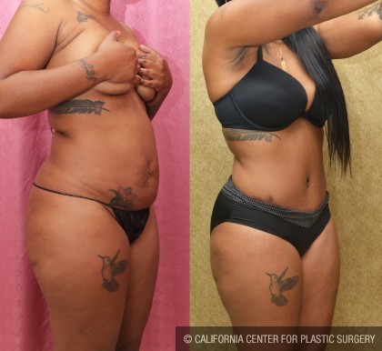 African American Tummy Tuck (Abdominoplasty) Before & After Patient #12559