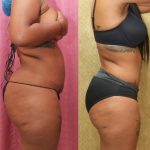 African American Tummy Tuck (Abdominoplasty) Before & After Patient #12559