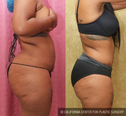 African American Tummy Tuck (Abdominoplasty) Before & After Patient #12559