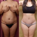 Tummy Tuck (Abdominoplasty) Small Size Before & After Patient #12600