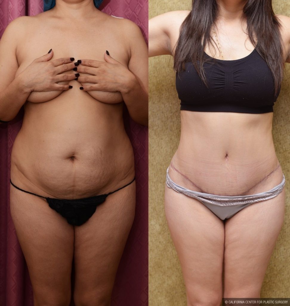 Tummy Tuck (Abdominoplasty) Small Size Before & After Patient #12600