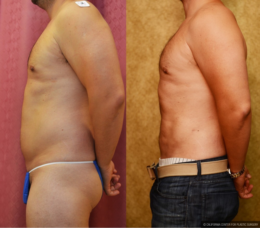 Male Liposuction Abdomen Before & After Patient #12532