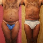 Male Liposuction Abdomen Before & After Patient #12527