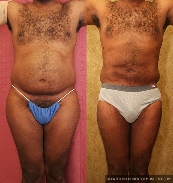 Male Liposuction Abdomen Before & After Patient #12527