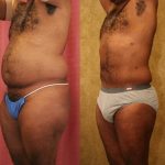 Male Liposuction Abdomen Before & After Patient #12527