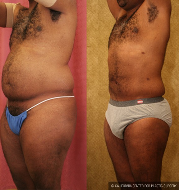 Male Liposuction Abdomen Before & After Patient #12527