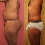 Male Liposuction Abdomen Before & After Patient #12527