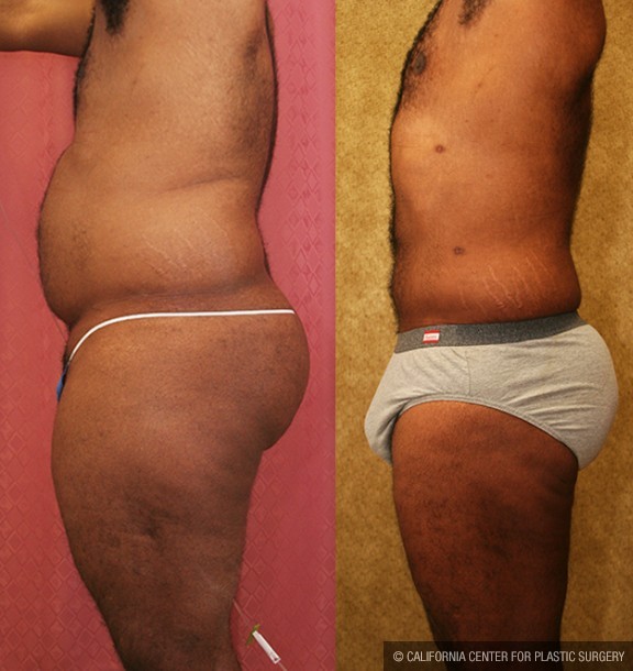 Male Liposuction Abdomen Before & After Patient #12527