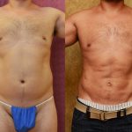 Male Liposuction Abdomen Before & After Patient #12532