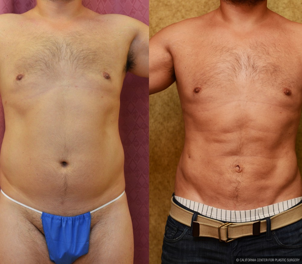 Male Liposuction Abdomen Before & After Patient #12532
