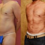 Male Liposuction Abdomen Before & After Patient #12532