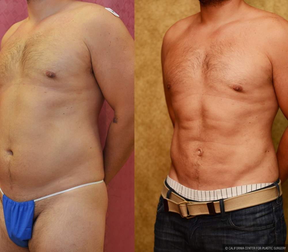 Male Liposuction Abdomen Before & After Patient #12532